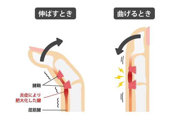 ばね指について